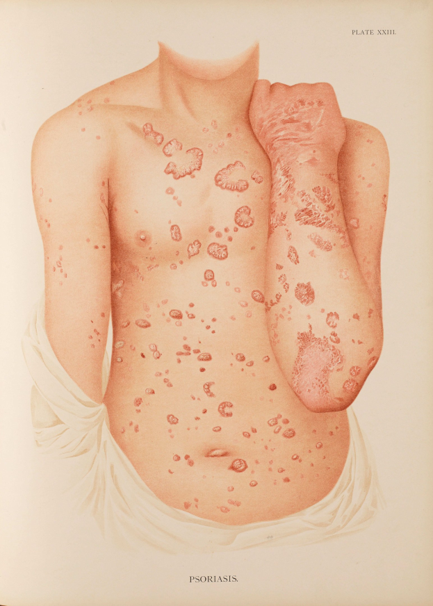 Ein Buchumschlag mit einer Illustration eines Männerkörpers mit roten Flecken, die wahrscheinlich Psoriasis darstellen, mit begleitendem Text zum Thema.